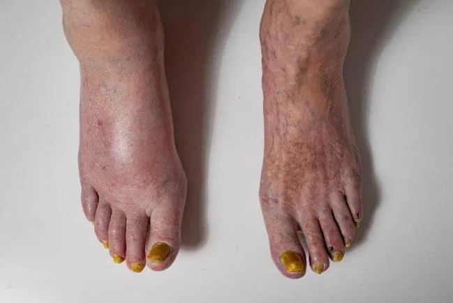 Two feet seen from above, one swollen and red, with thickened yellow toenails